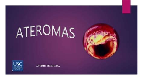 Ateroma