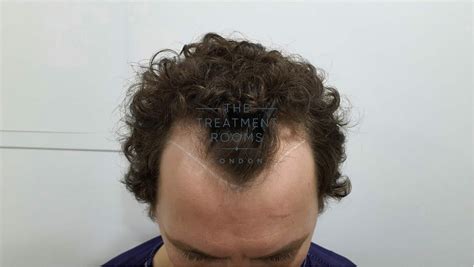 What Is A Widow's Peak? | The Treatment Rooms London