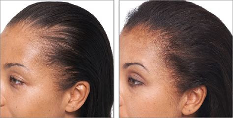 Keranique Reviews | Does Keranique Work To Regrow Hair