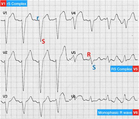 Left Bundle Branch Block (LBBB) • LITFL • ECG Library Diagnosis