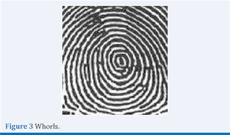 Figure 3 from Dermatoglyphics in Health and Oral Diseases-A Review ...