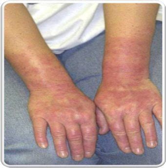 URTICARIA: CLASSIFICATION AND CAUSES