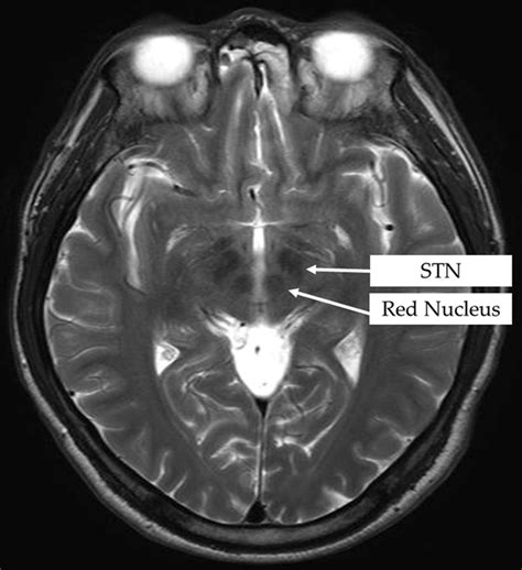 Deep Brain Stimulation: The Perspective of Brain Connectivity | IntechOpen