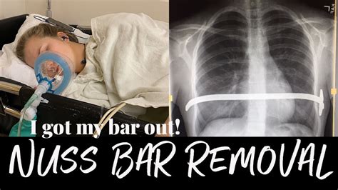 Nuss Bar Removal Surgery | My Pectus Excavatum Journey - YouTube