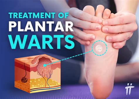 Plantar Warts: Treatments & Removal - Turan&Turan