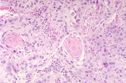 Squamous Cell Carcinoma Lung Histology