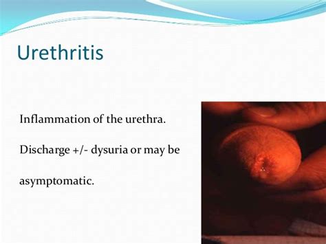 Urethritis