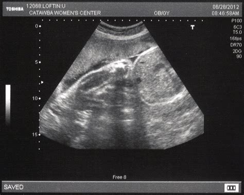 Ultrasound (30 weeks) – Philip, Leslie & Kayli