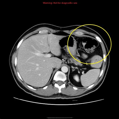 Stomach cancer CT - wikidoc
