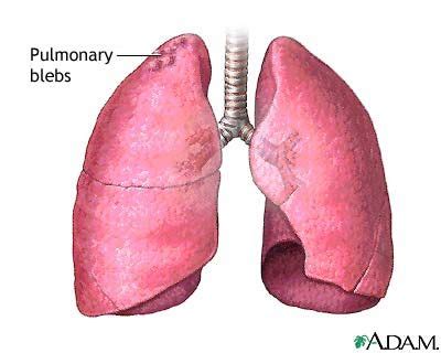 Pin on Spontaneous Pneumothorax