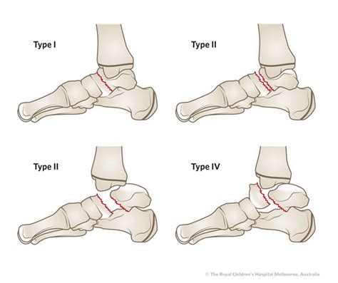 Clinical Practice Guidelines : Talus Fractures: Emergency Department