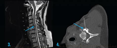 Adult MRI Series - MRI of Cervical spine: Radiculopathy