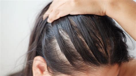 What Causes Hair Loss in Women? Causes & Treatments | Philip Kingsley