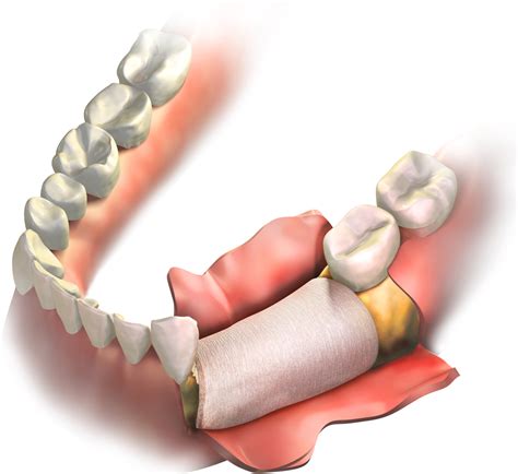 Bone grafting may be a necessary part of the implant process to prepare ...