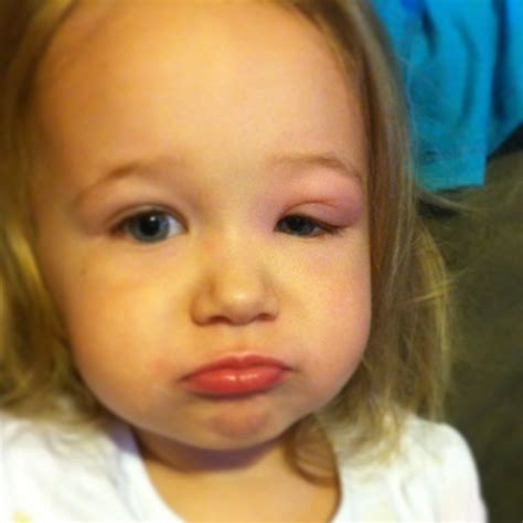 SweetPea has allergies. :( - Nanny to Mommy