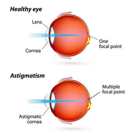 Astigmatism - Byrne's Opticians