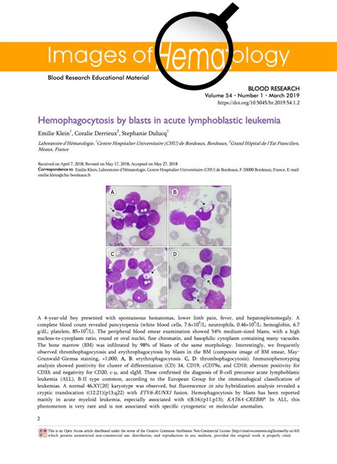 (PDF) Hemophagocytosis by blasts in acute lymphoblastic leukemia