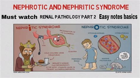 Nephrotic and nephritic syndrome - Causes , introduction EASY NOTES - YouTube