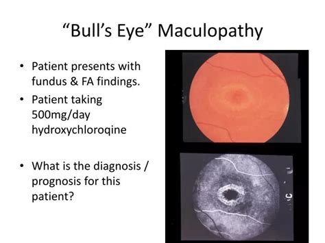 PPT - “Bull’s Eye” Maculopathy PowerPoint Presentation - ID:1898377