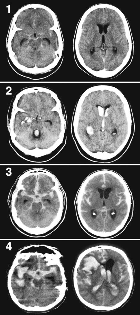 9.15-Fisher scale | Diagnostický a terapeutický manuál cévních onemocnění mozku