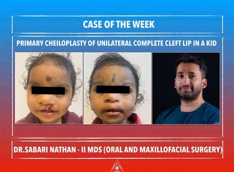 Primary Unilateral Cheiloplasty — Oral & Maxillofacial Surgery