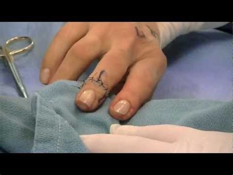 DIP Arthrodesis Surgery by Dr. Thomas Trumble - YouTube