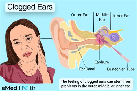 Clogged Ears: Causes, Symptoms, and Treatment Options