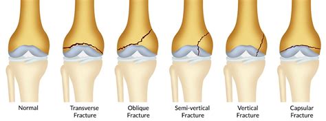 The most common knee injuries and disorders - kneesafe.com