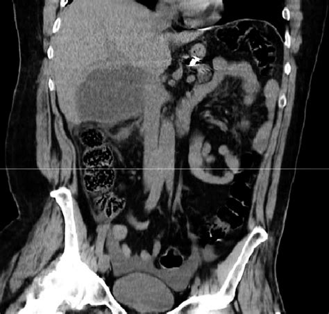 CT scan-coronal view: hypodense lesion in segment VI of the liver. | Download Scientific Diagram