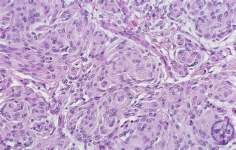 17.Nervous system (9) Meningioma|Pathology Core Pictures