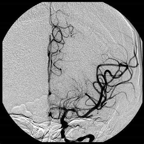 Carotid Artery Blockage Symptoms and Treatments – CCL Leaders