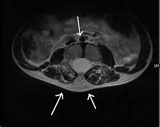 Lipomyelomeningocele-MRI - Sumer's Radiology Blog