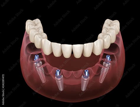 Mandibular prosthesis All on 4 system supported by implants. Medically ...