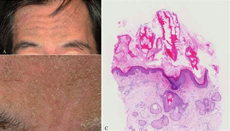 Clinical appearance and histology. (A) Lichen spinulosus on the... | Download Scientific Diagram