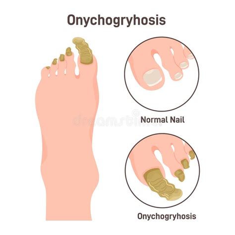 Onychogryphosis or Ram S Horn Nails. Nail Disease, when Toenails Stock Vector - Illustration of ...