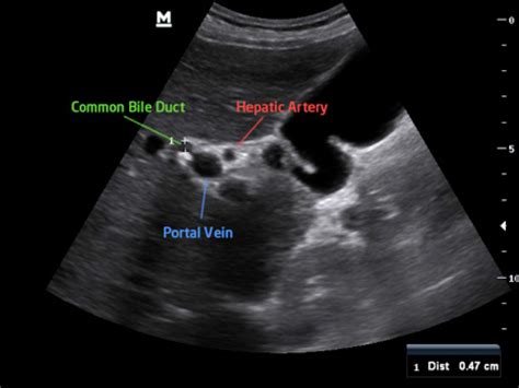 Biliary Ultrasound – Core EM