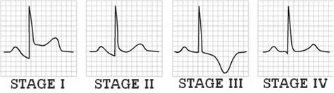 Study Medical Photos: Pericarditis - A Brief Discussion And Description Of ECG Changes