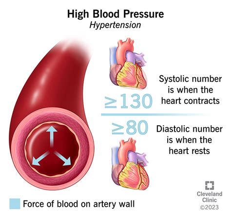 High Blood Pressure: Symptoms & Causes