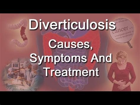 Diverticulosis Causes, Symptoms And Treatment - YouTube