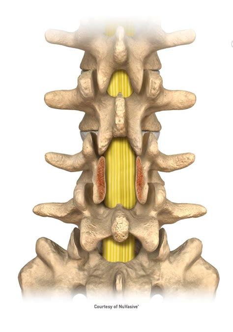 Lumbar Spine – Laminectomy/Laminotomy | Precision Spine & Orthopedics Inc