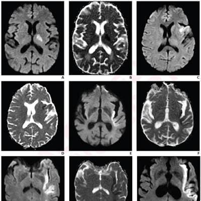 Stroke indicator found on MRI could help with treatment strategies | AuntMinnie