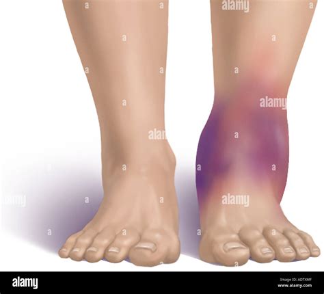 Swelling and Bruising of the Ankle Stock Photo, Royalty Free Image ...