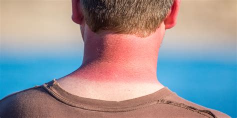 Getting Really Bad Sunburns As A Teen Could Raise Skin Cancer Risk | HuffPost