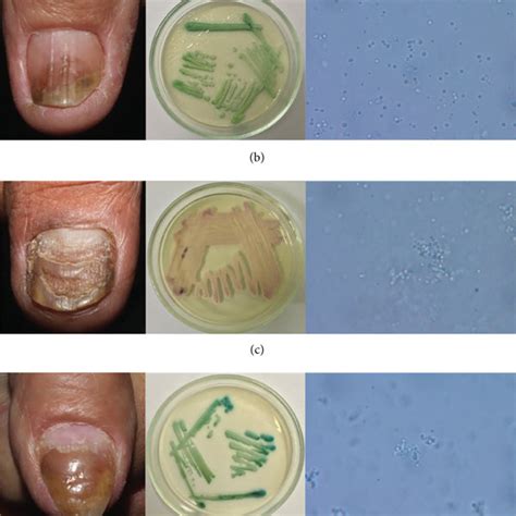 Total dystrophic onychomycosis: Ruinous aspect of subungual... | Download Scientific Diagram