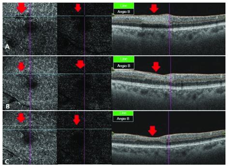 OCT angiography at different stages of RAO. (A) After two weeks, OCT ...