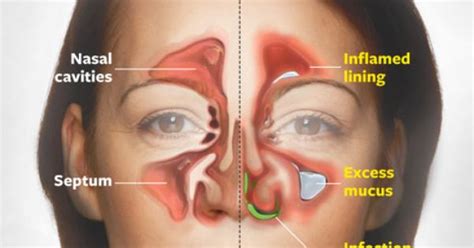 Acute sinusitis (acute rhinosinusitis) causes the cavities around your nasal passages (sinuses ...