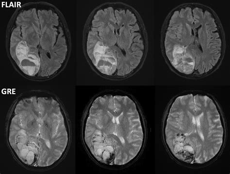 Acute Ischemic Stroke Ct Scan Ct Scan Machine Images - vrogue.co