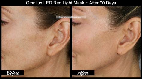 OmniLux LED Mask ~ 3 Month Results! Before & After Face, Neck, & Hand ...