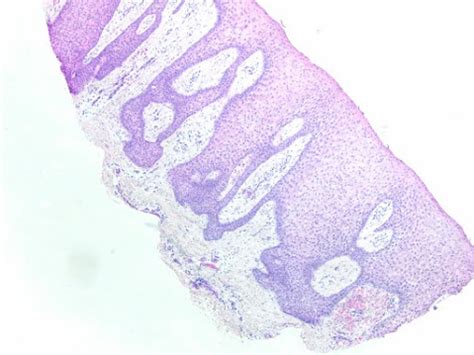 Pathology Outlines - Clear cell acanthoma