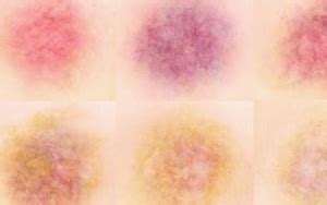 Stages of Bruising Colors, Pictures, Chart and Different Bruise Healing ...